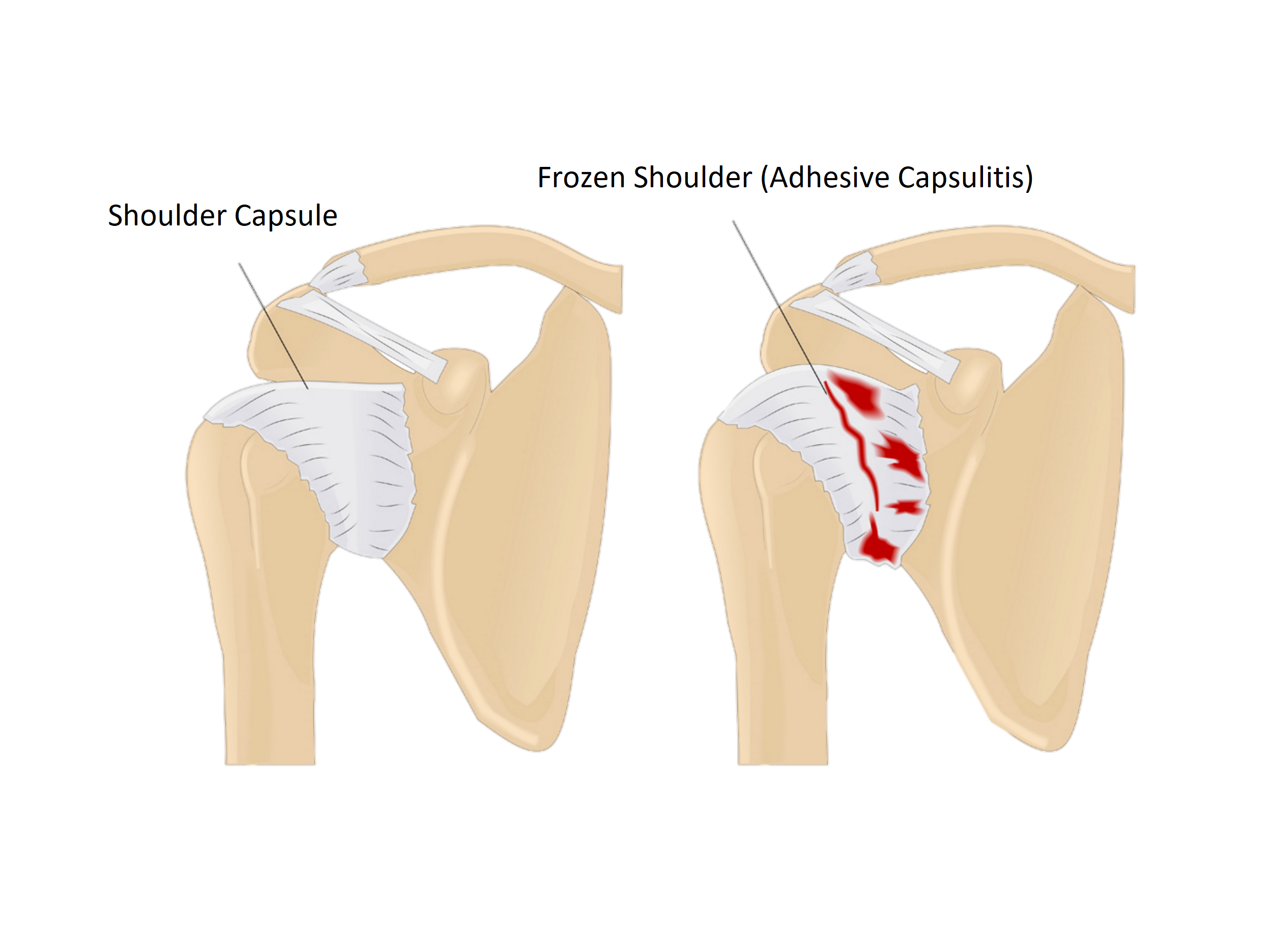 Frozen Shoulder Image