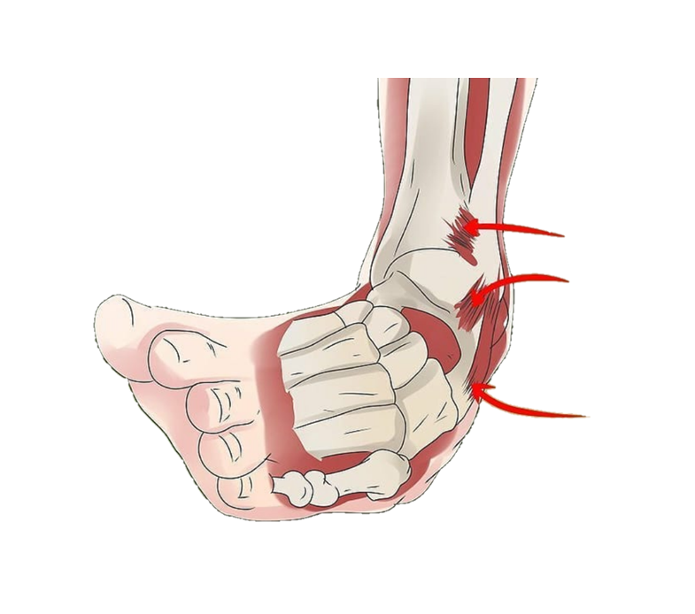 Ankle Sprain Image