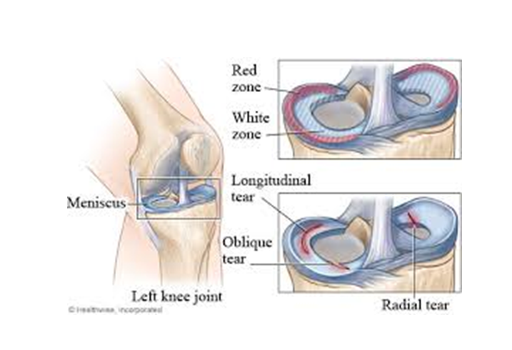 Meniscus Tear Image