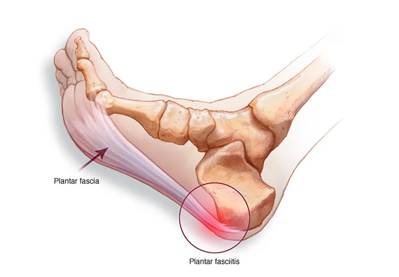 Plantar Fasciitis Image