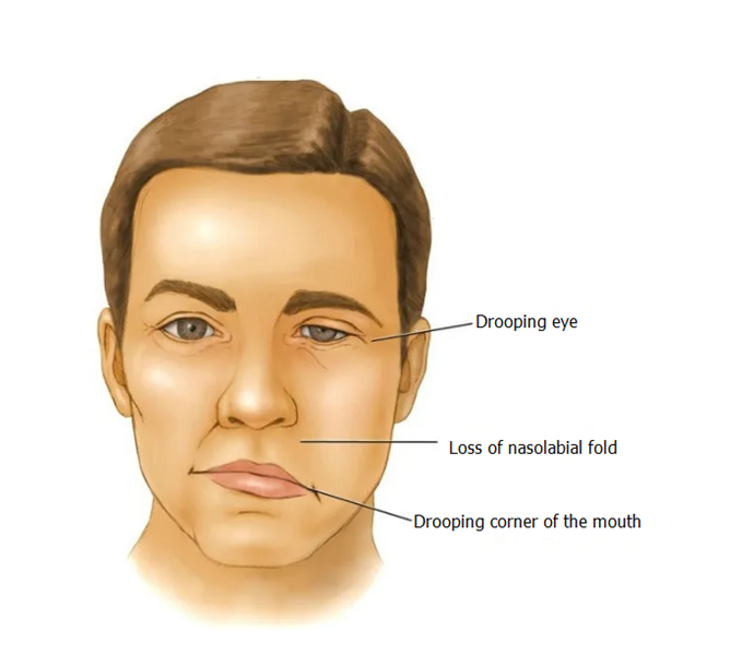 Fascial Nerve Paralysis Image