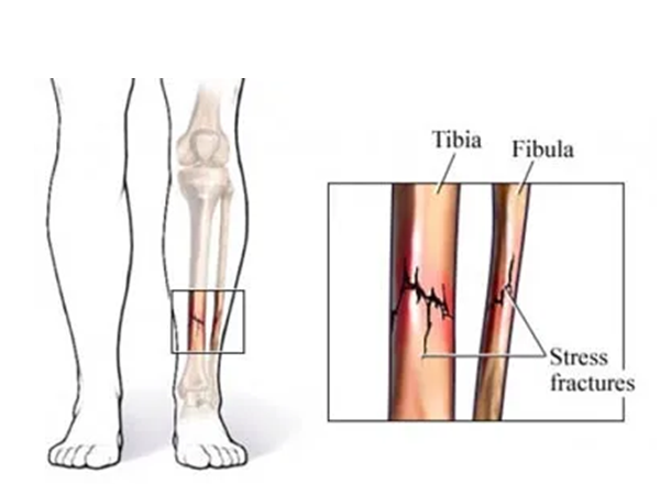 Stress Fracture Image
