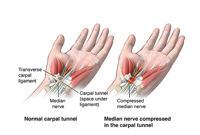 Carpal Tunnel Syndrome Image