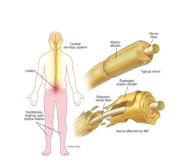 Multiple Sclerosis Image