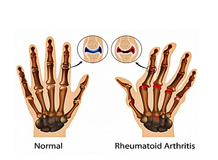 Rheumatoid Arthritis Image