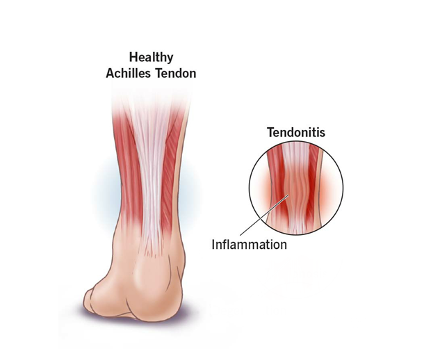 Tendonitis Image