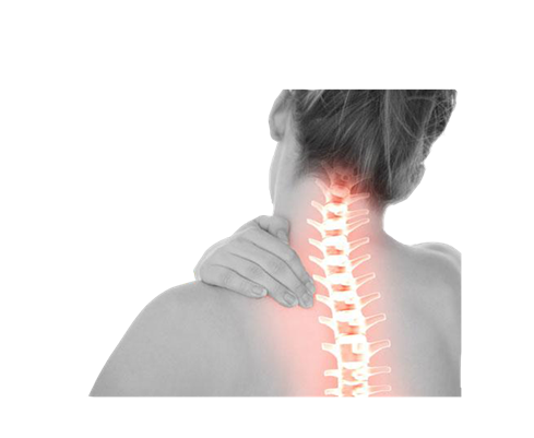 Cervical Syndrome Image