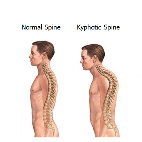 Kyphosis Image