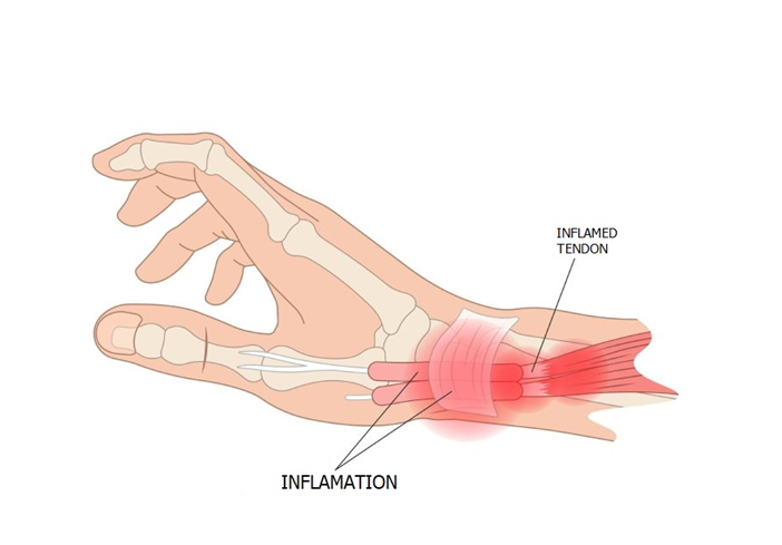 De Quervain Tenosynovitis Image